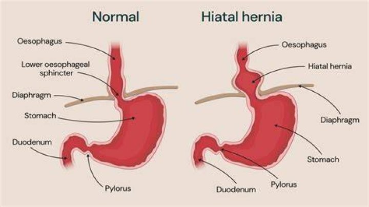 Can a hiatal hernia cause right upper quadrant pain?