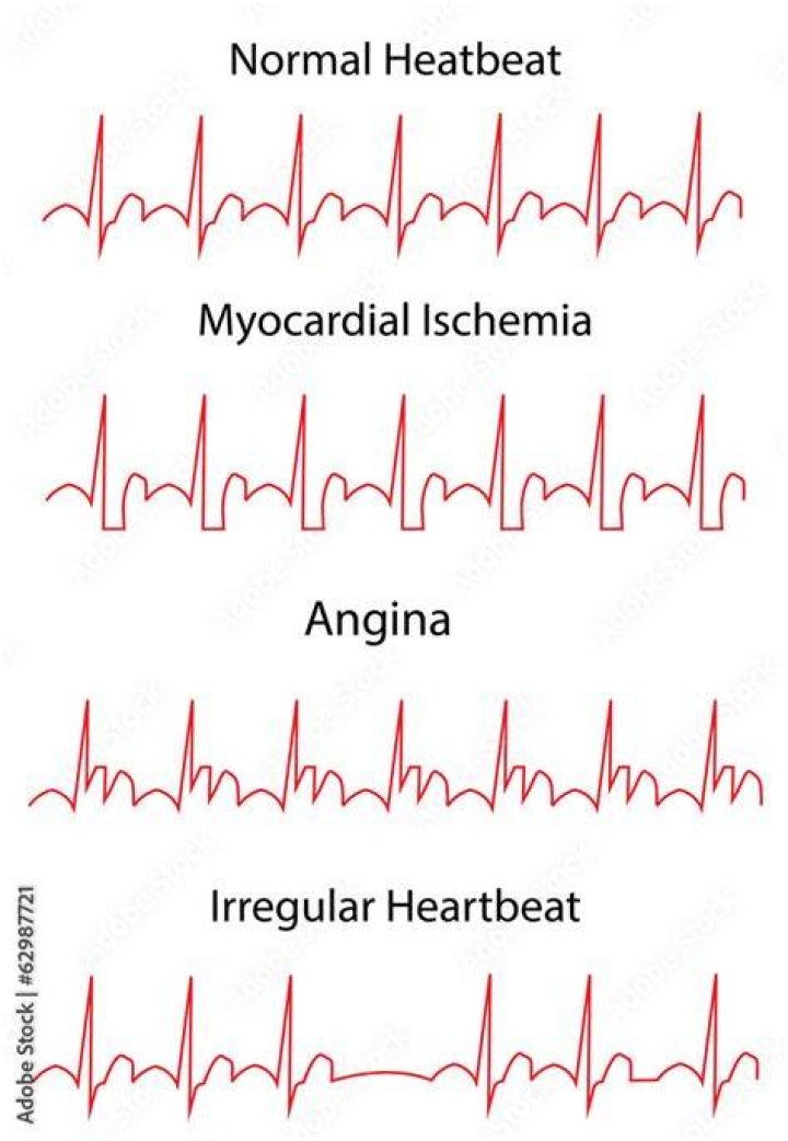 Can an ECG detect angina?
