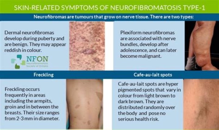 Can neurofibromatosis be prevented?