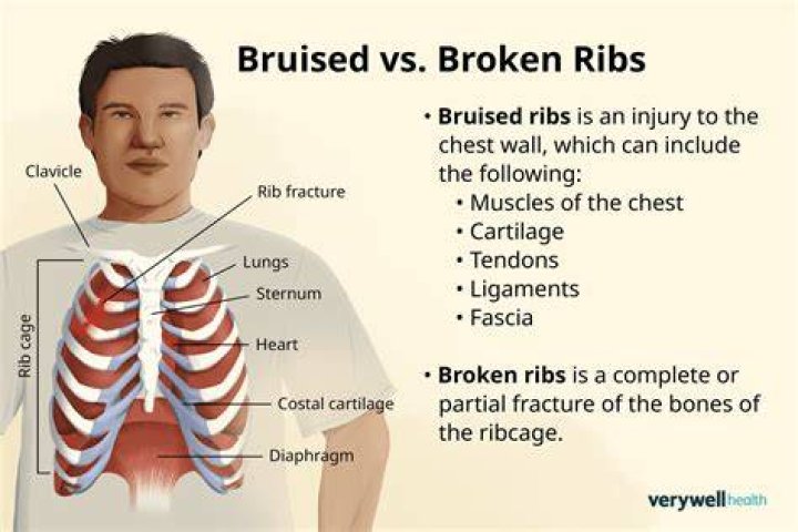 How serious is 8 broken ribs?