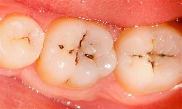 Is a black spot on tooth a cavity?