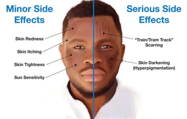 What are the side effects of microneedling?