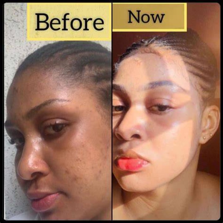 What is the safest way to bleach skin?