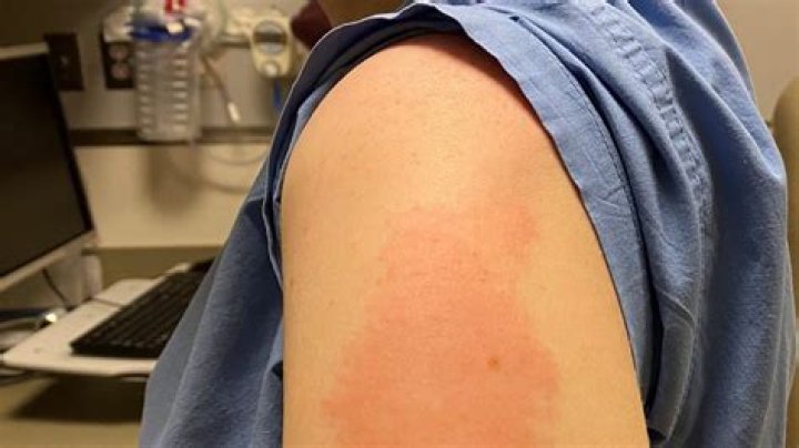 What should I do if I am allergic to the COVID-19 vaccine?