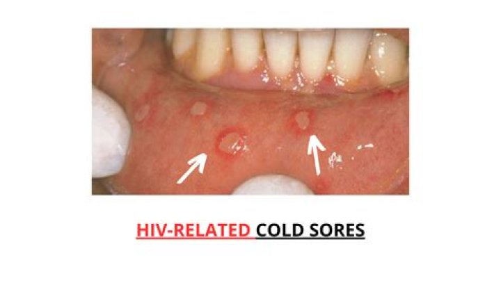 What virus causes mouth sores?